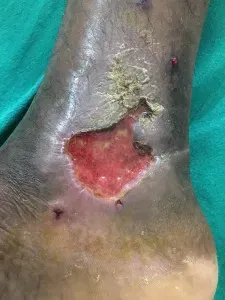 Varicose Ulcer