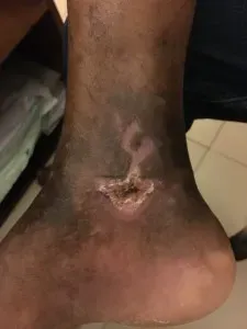 Varicose Ulcer after 7 days treatment