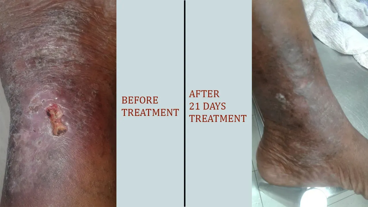 Varicose ulcer picture before and after varicose ulcer treatment in Calicut.
