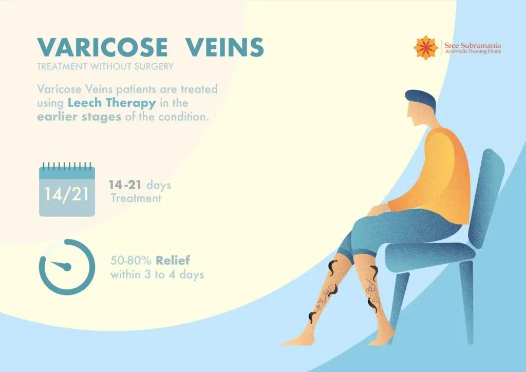 Effectiveness of leech therapy as a varicose veins treament option