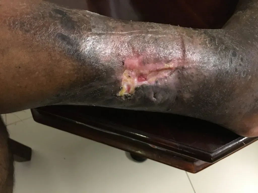 Before Treatment