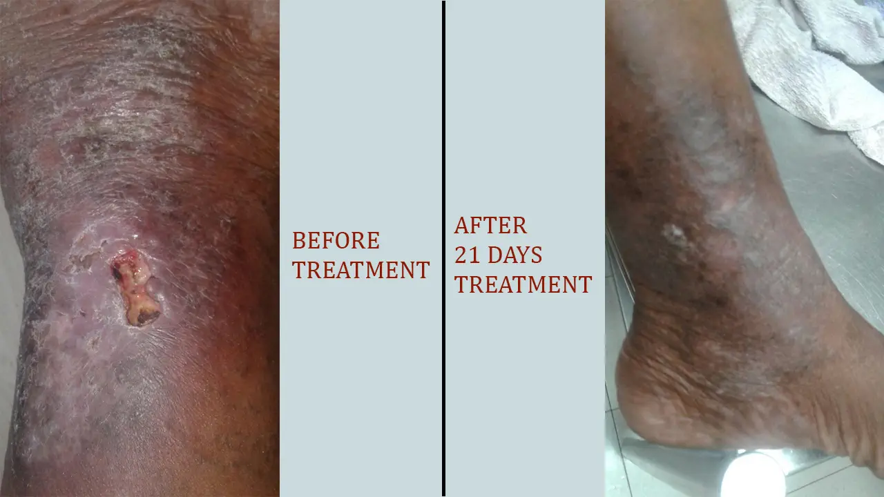 varicose-ulcer-picture (1) Varicose ulcer picture before and after varicose ulcer treatment in Calicut.