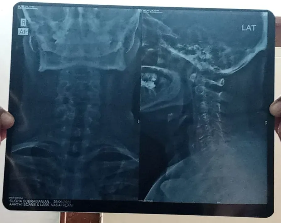 curvical-x-ray