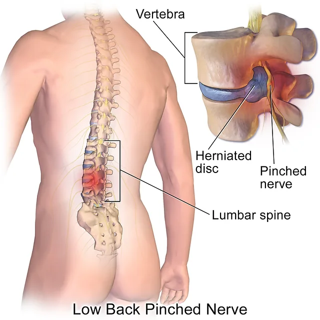back-pain-pic