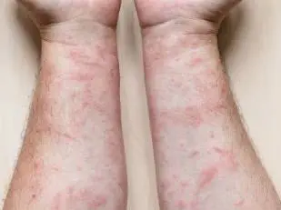 Guttate Psoriasis