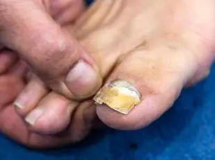 Nail Psoriasis
