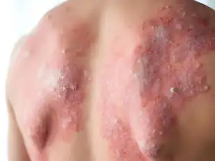 Plaque Psoriasis