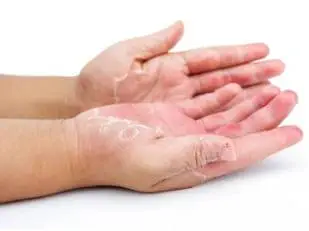 Pustular psoriasis