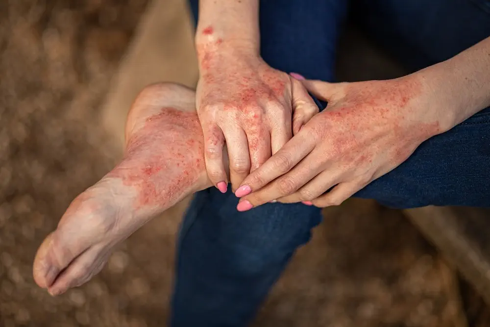 Eczema,Dermatitis,On,Hands,And,Feet.,Red,Spots,On,The Best Treatment for Psoriasis