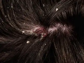scalp