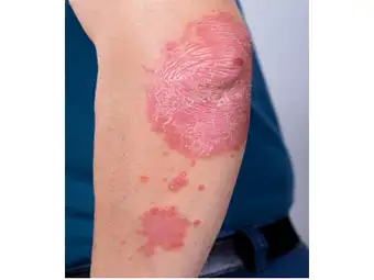 soriasis